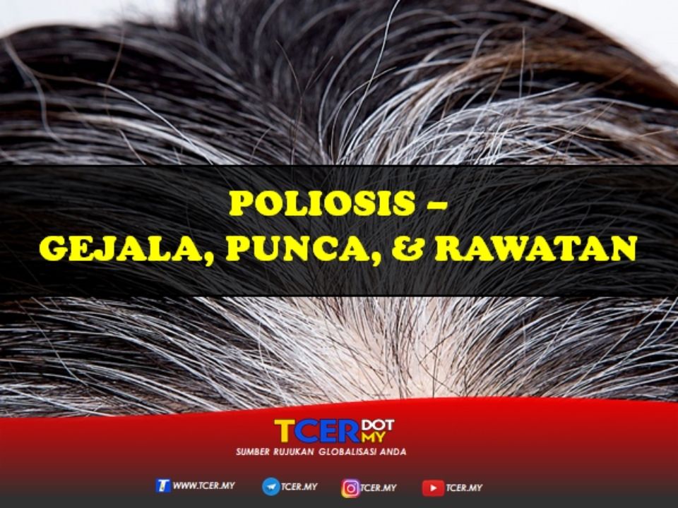 Poliosis Gejala Punca Dan Rawatan Tcer My