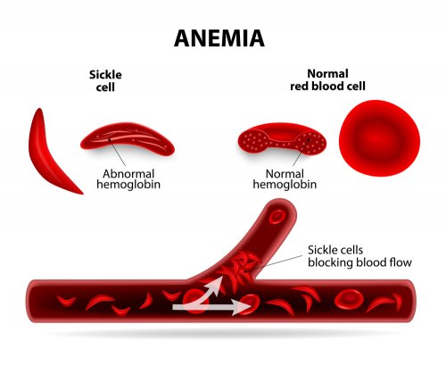 Penyakit Anemia-Gejala, Penyebab Dan Rawatan - TCER.MY