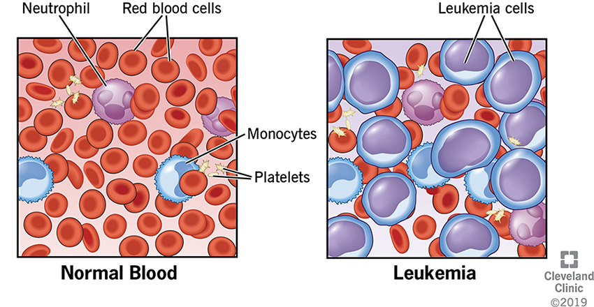 leukemia-penyebab-tanda-tanda-dan-rawatan-tcer-my