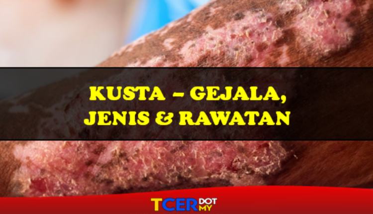 Kusta Gejala Jenis Dan Rawatan Tcermy 