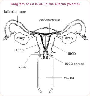 IUCD: Ini 5 Risiko & Fungsi Sebenar Penggunaanya 1