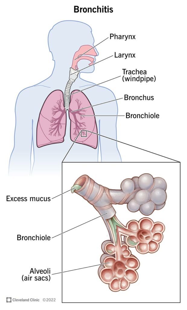 2 Jenis Bronkitis: Simptom, Punca, Diagnosis & Ujian 1