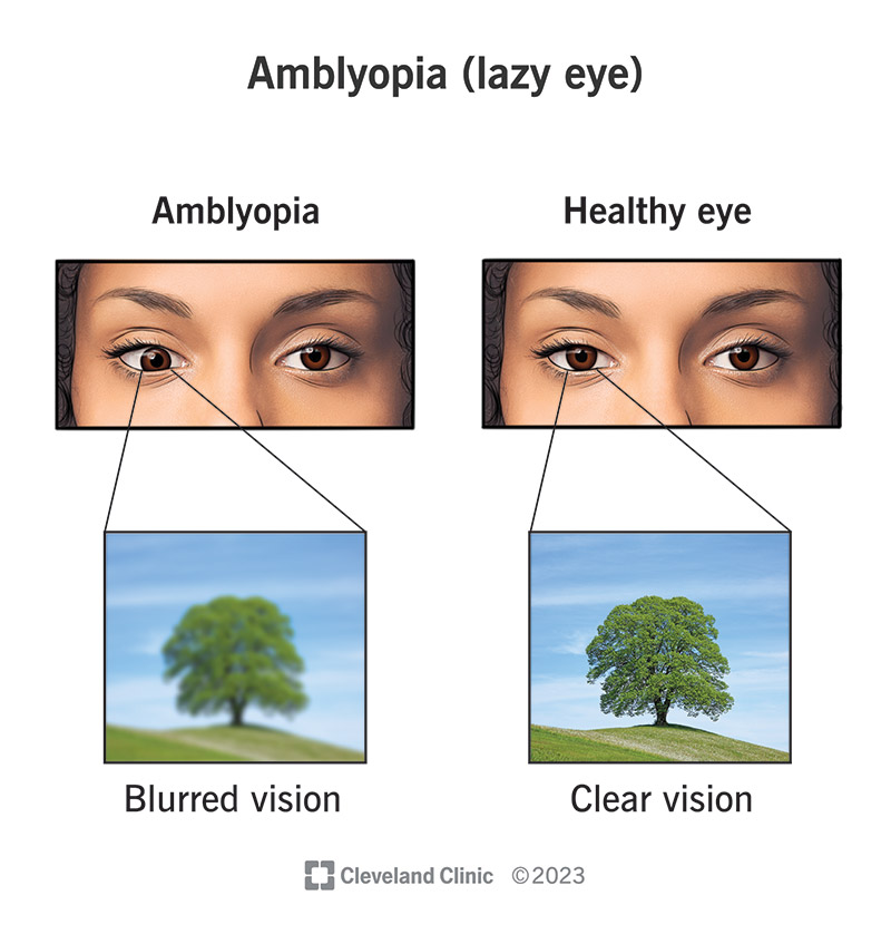 Lazy Eye (Amblyopia): Ini 3 Penyebab Utama Keadaan Ini Boleh Terjadi 1