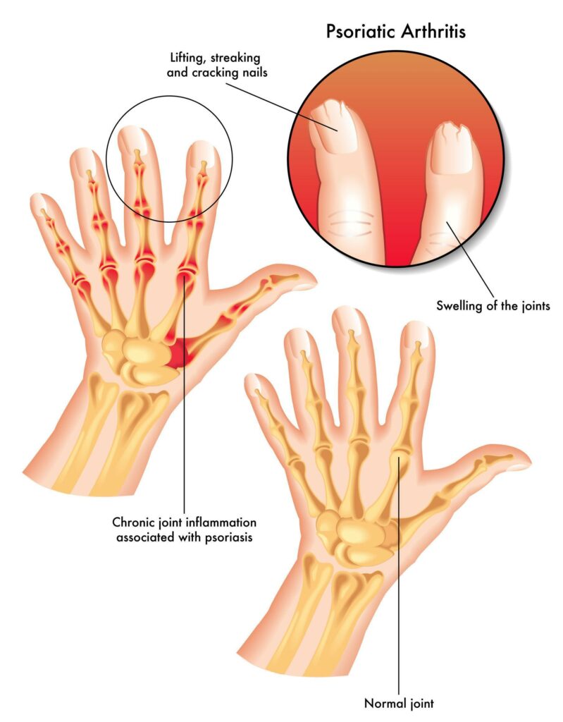 5 Jenis Psoriasis, Simptom, Punca & Rawatan Pencegahannya 3