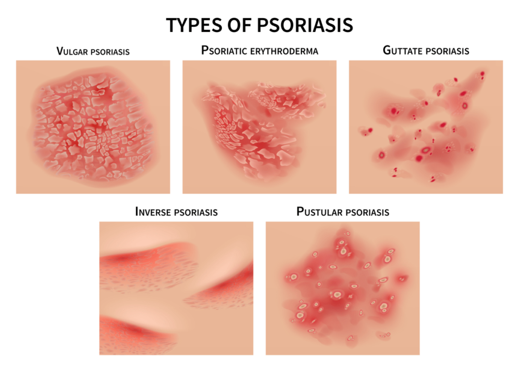 5 Jenis Psoriasis, Simptom, Punca & Rawatan Pencegahannya 1