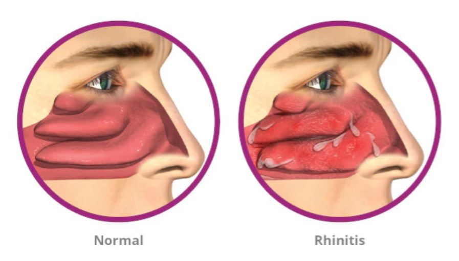 Allergic Rhinitis: Simptom, Punca & Rawatan Pencegahan 1