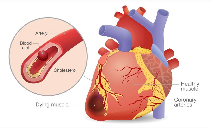 Myocardial Infarction: Simptom, Punca/Faktor Risiko & Pencegahan 3