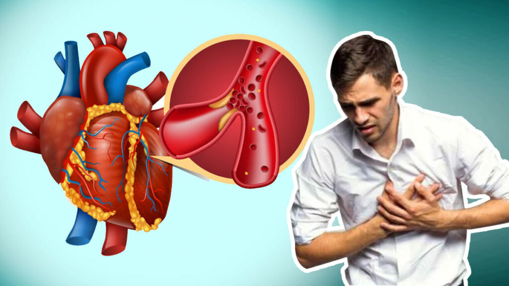 Myocardial Infarction: Simptom, Punca/Faktor Risiko & Pencegahan 1