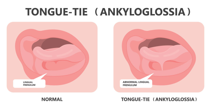 Tongue Tie: Simptom, Punca, Diagnosis & Rawatan 1