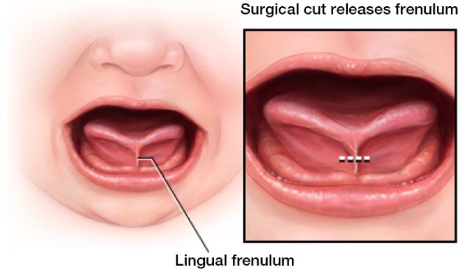 Tongue Tie: Simptom, Punca, Diagnosis & Rawatan 3