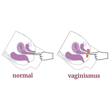 Apa Itu Vaginismus? Info Penting Untuk Semua Wanita! 1