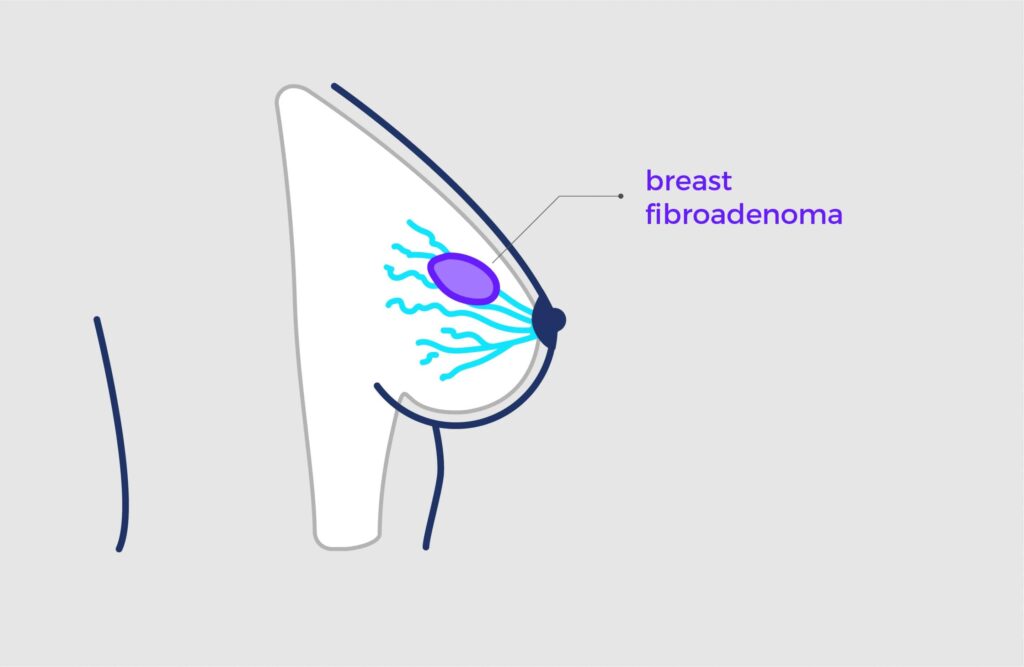 Apa Itu Fibroadenoma? Semua Wanita Perlu Ambil Tahu! 1