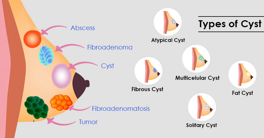 Apa Itu Fibroadenoma? Semua Wanita Perlu Ambil Tahu! 3