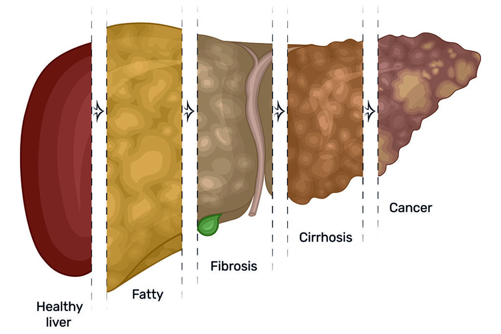 Fatty Liver: Jenis, Simptom, Punca, Komplikasi & Langkah Pencegahan 3