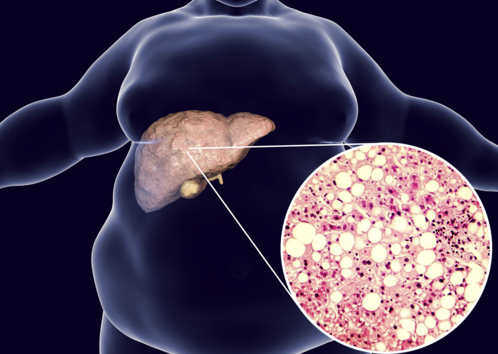 Fatty Liver: Jenis, Simptom, Punca, Komplikasi & Langkah Pencegahan 1