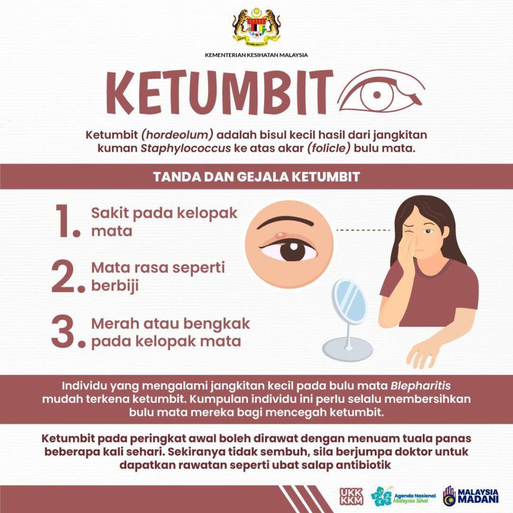 Stye: Jenis, Tanda & Gejala, Punca Dan Cara Merawat 1