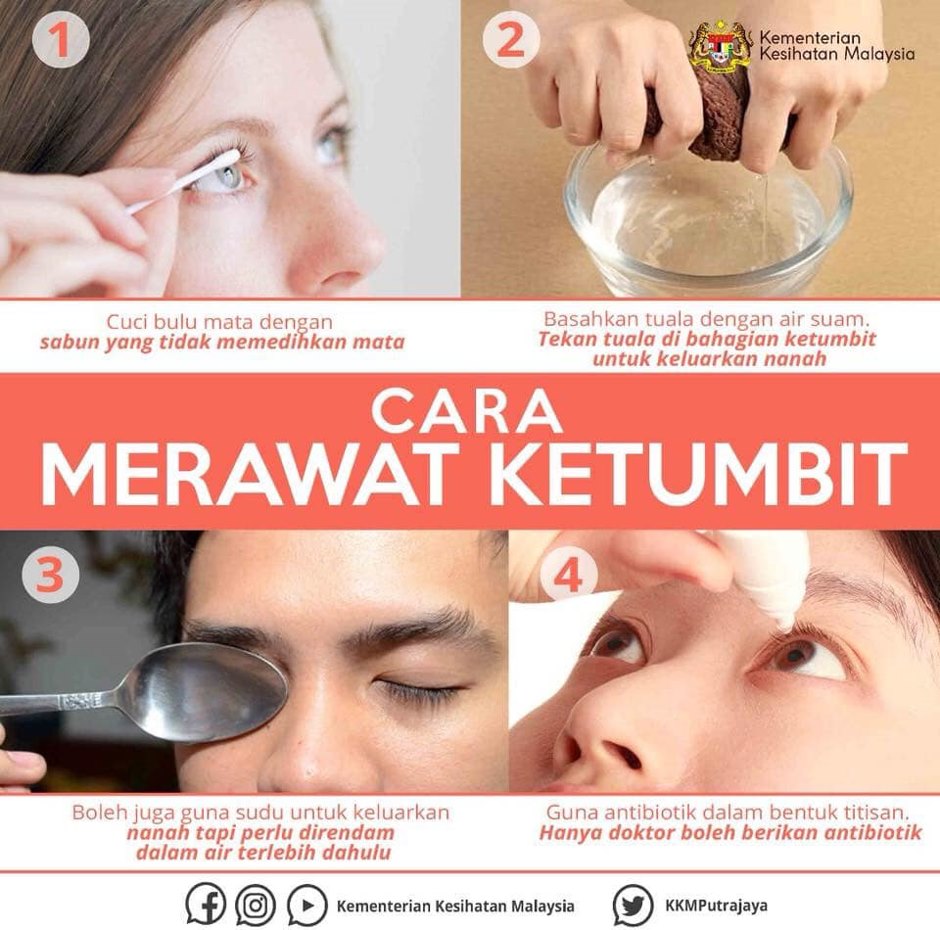 Stye: Jenis, Tanda & Gejala, Punca Dan Cara Merawat 3